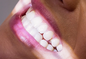 Clareamento Dental e Lentes